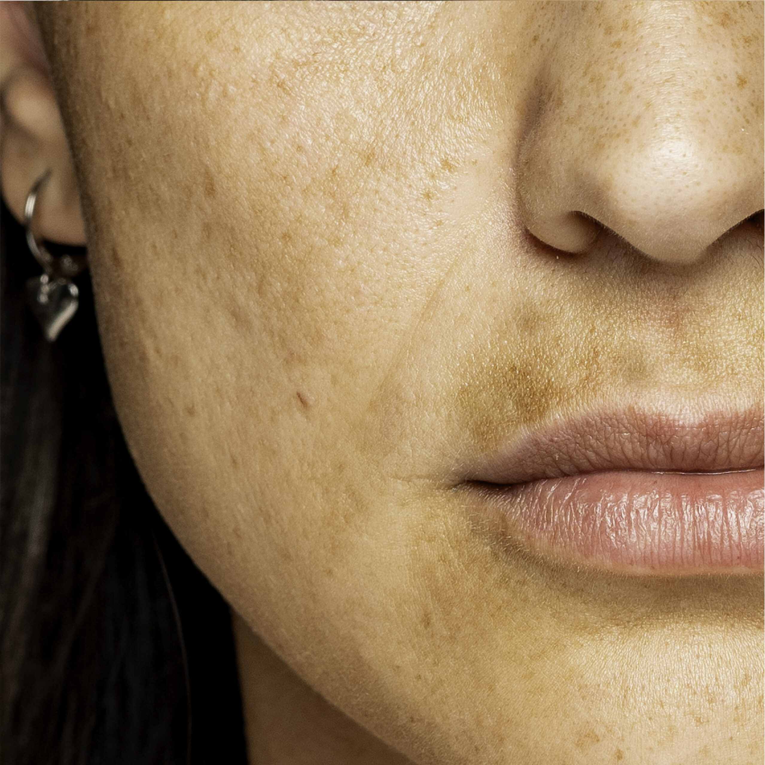 Clinical Study: Injectable Tranexamic Acid with niacinamide for Skin Lightening